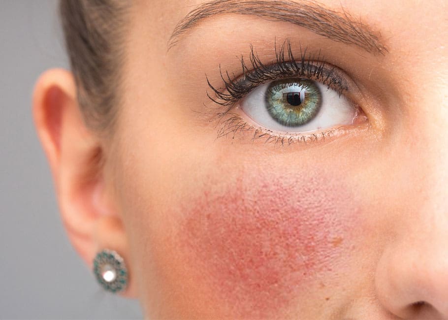 woman with rosacea