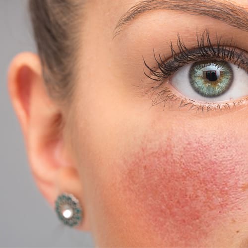 rosacea