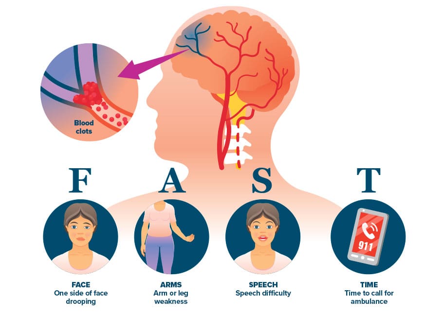 illustration of stroke symptoms