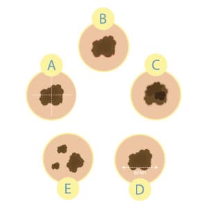 examples of troublesome moles