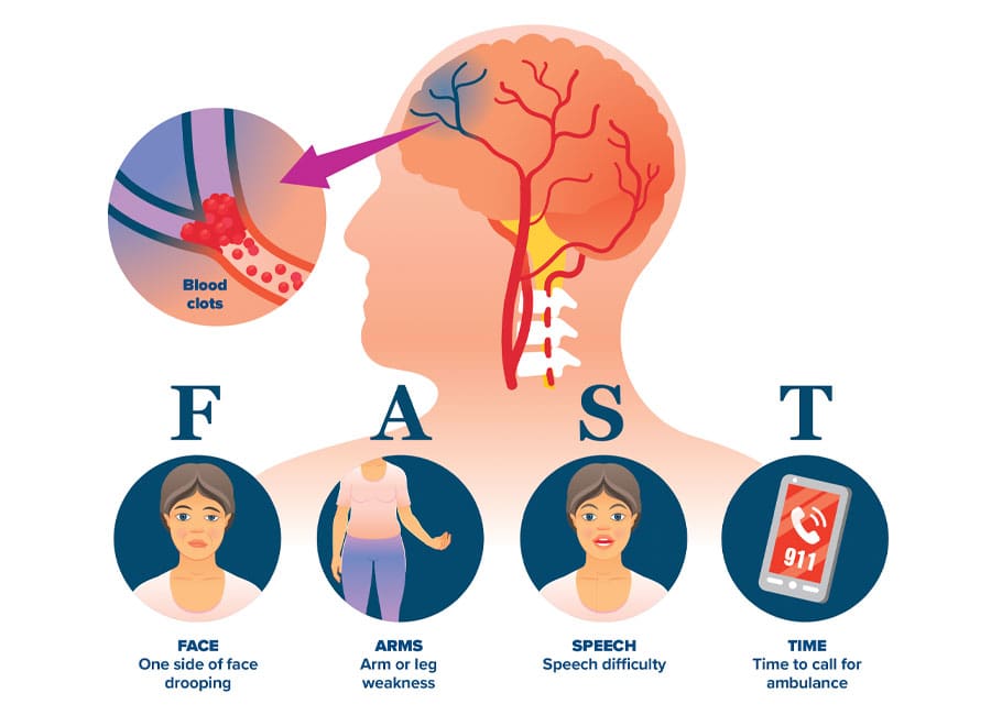 info graphic about strokes