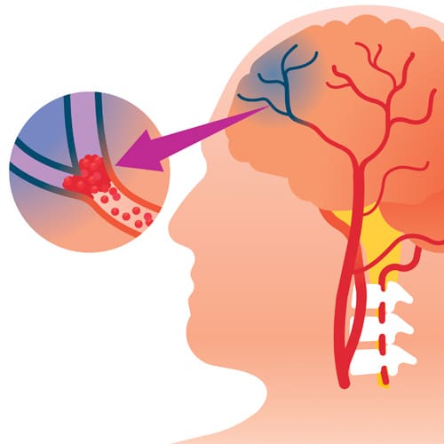 illustration of stroke hitting the brain